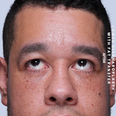 Eyes Before & After Gallery - Patient 117878 - Image 4