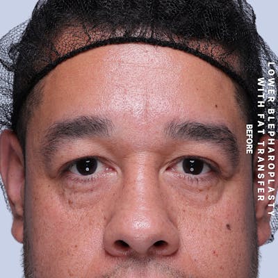Eyes Before & After Gallery - Patient 117878 - Image 1