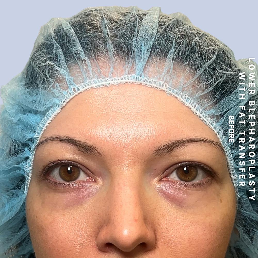 Eyes Before & After Gallery - Patient 104225 - Image 1