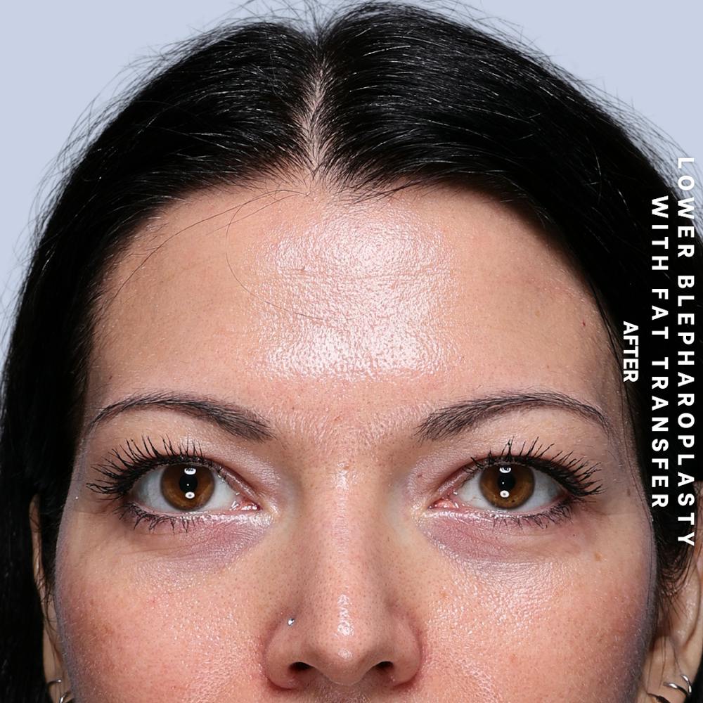 Eyes Before & After Gallery - Patient 104225 - Image 2