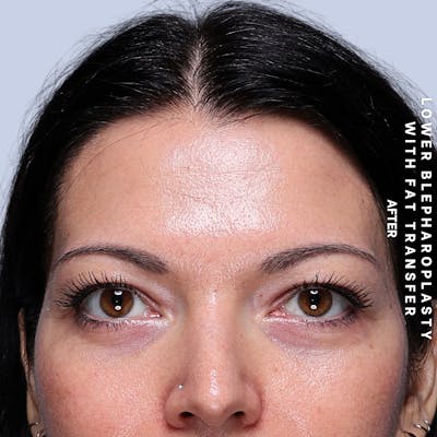 Eyes Before & After Gallery - Patient 104225 - Image 2