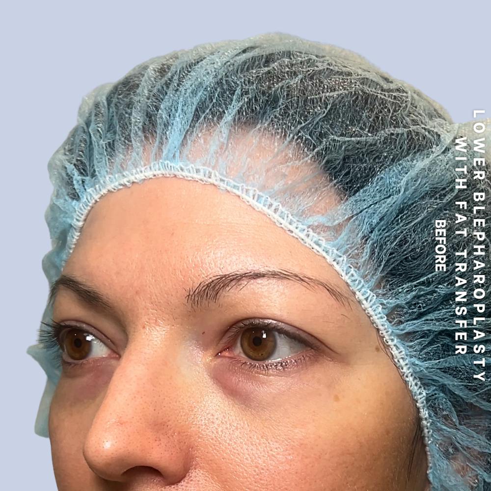 Eyes Before & After Gallery - Patient 104225 - Image 5