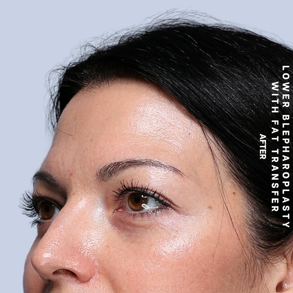 Eyes Before & After Gallery - Patient 104225 - Image 6