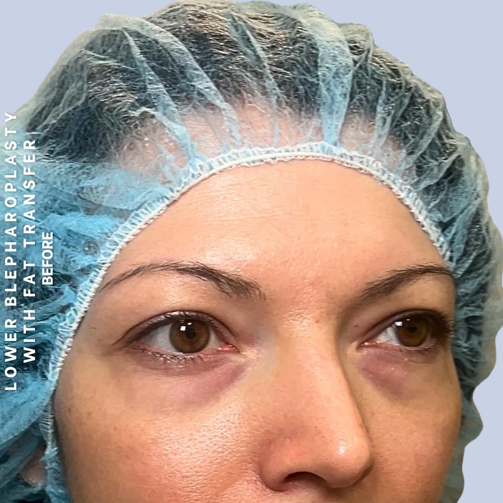 Eyes Before & After Gallery - Patient 104225 - Image 3