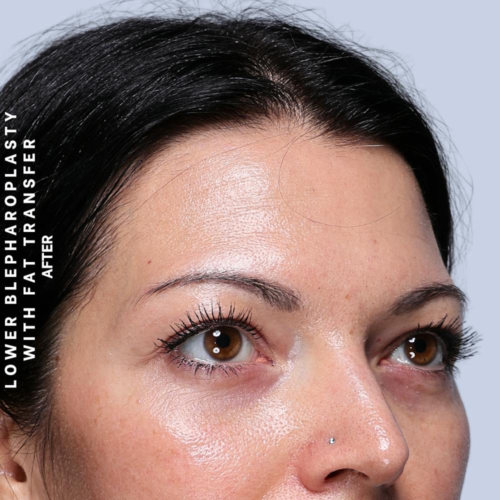 Eyes Before & After Gallery - Patient 104225 - Image 4