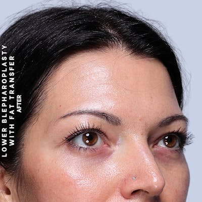 Eyes Before & After Gallery - Patient 104225 - Image 4