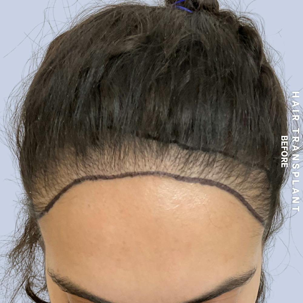 Hair Restoration Before & After Gallery - Patient 463895 - Image 3