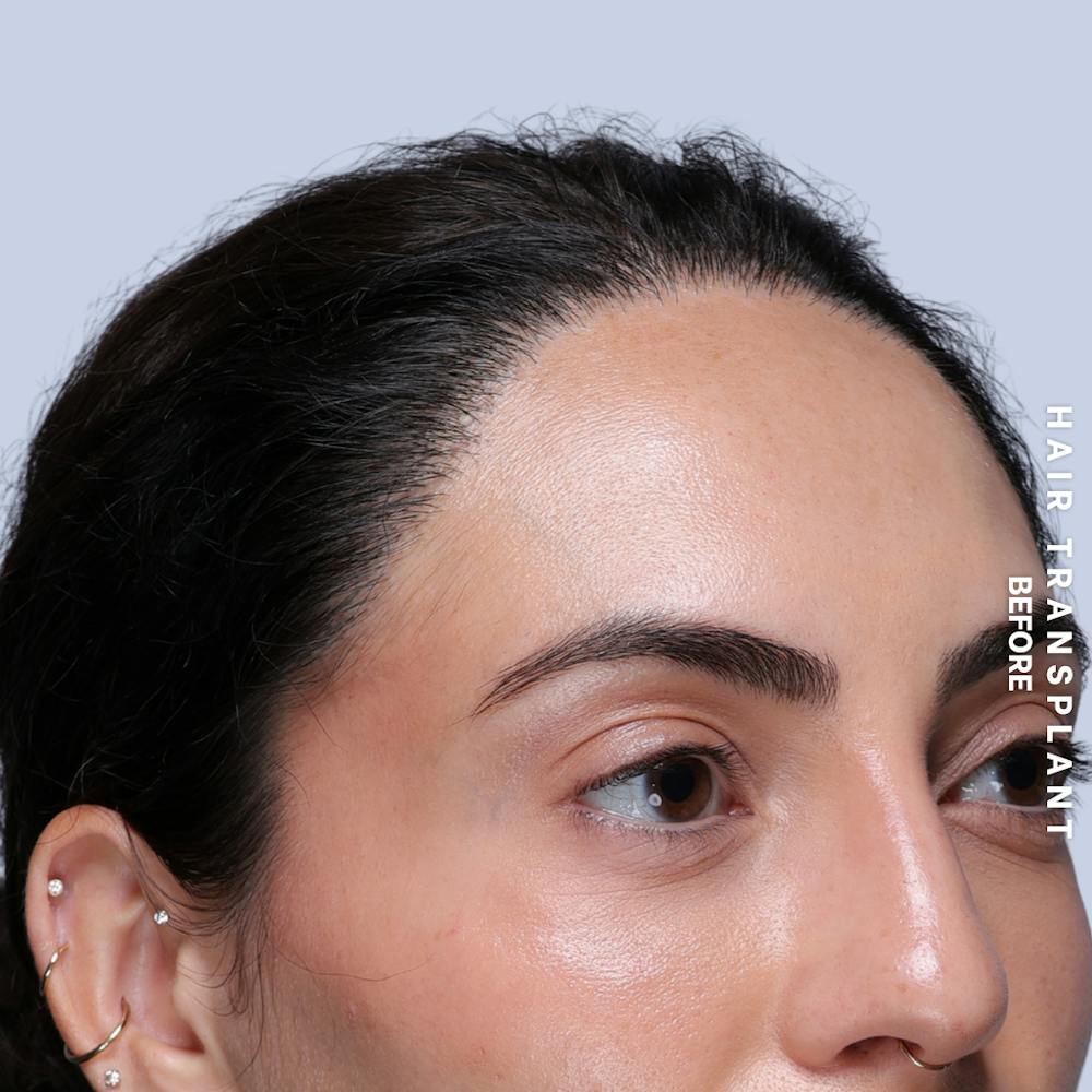 Hair Restoration Before & After Gallery - Patient 463895 - Image 6