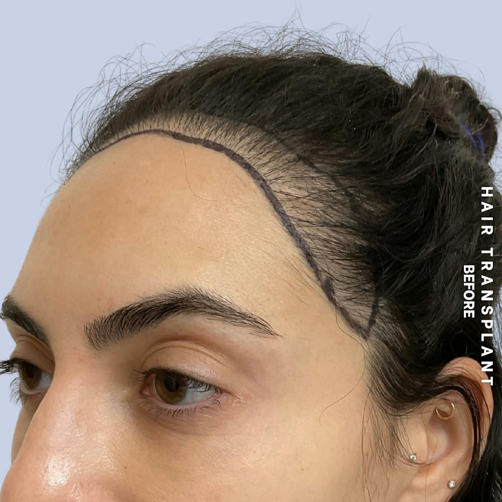Hair Restoration Before & After Gallery - Patient 463895 - Image 9