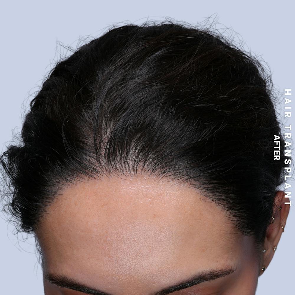 Hair Restoration Before & After Gallery - Patient 463895 - Image 4