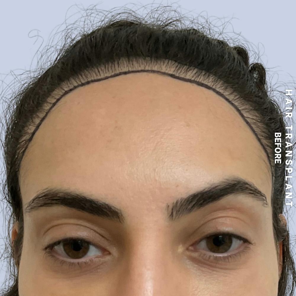 Hair Restoration Before & After Gallery - Patient 463895 - Image 1