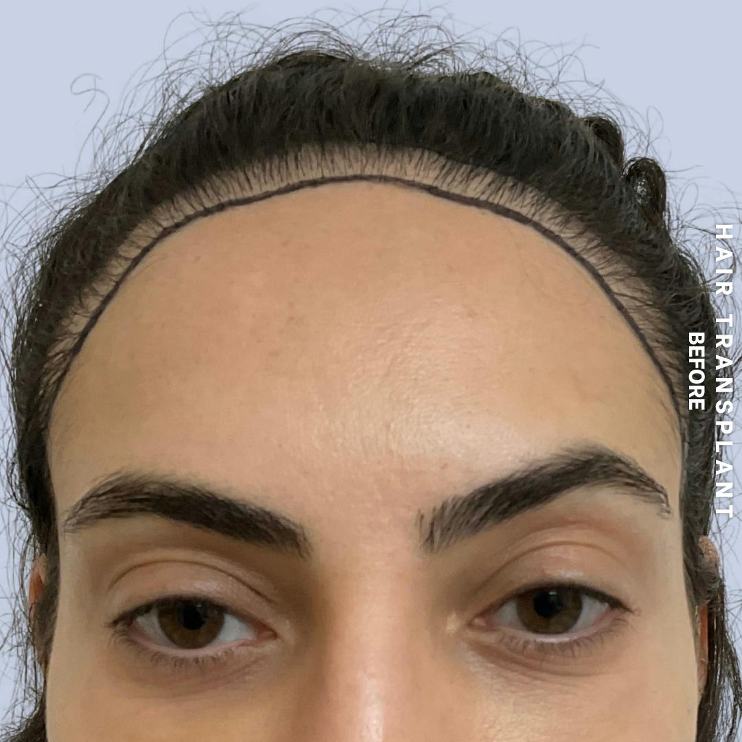 Hair Restoration Before & After Gallery - Patient 463895 - Image 1