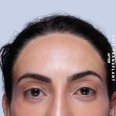 Hair Restoration Before & After Gallery - Patient 463895 - Image 2