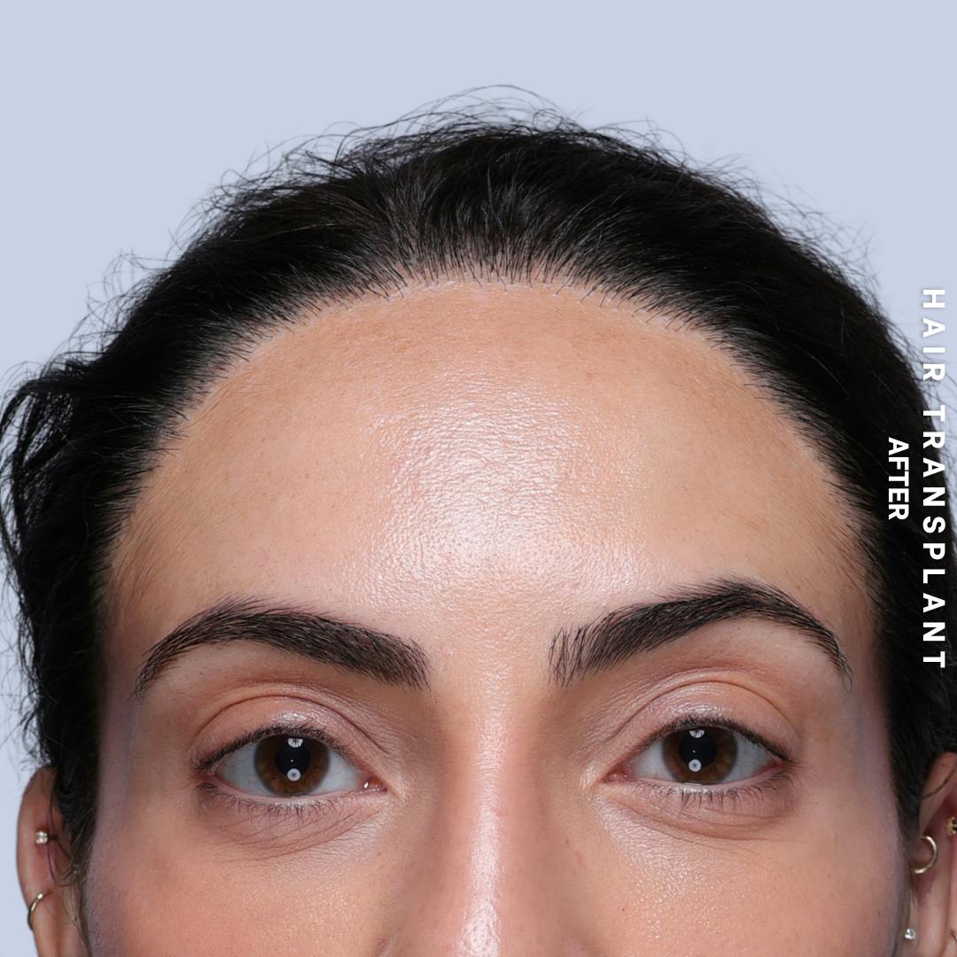 Hair Restoration Before & After Gallery - Patient 463895 - Image 2