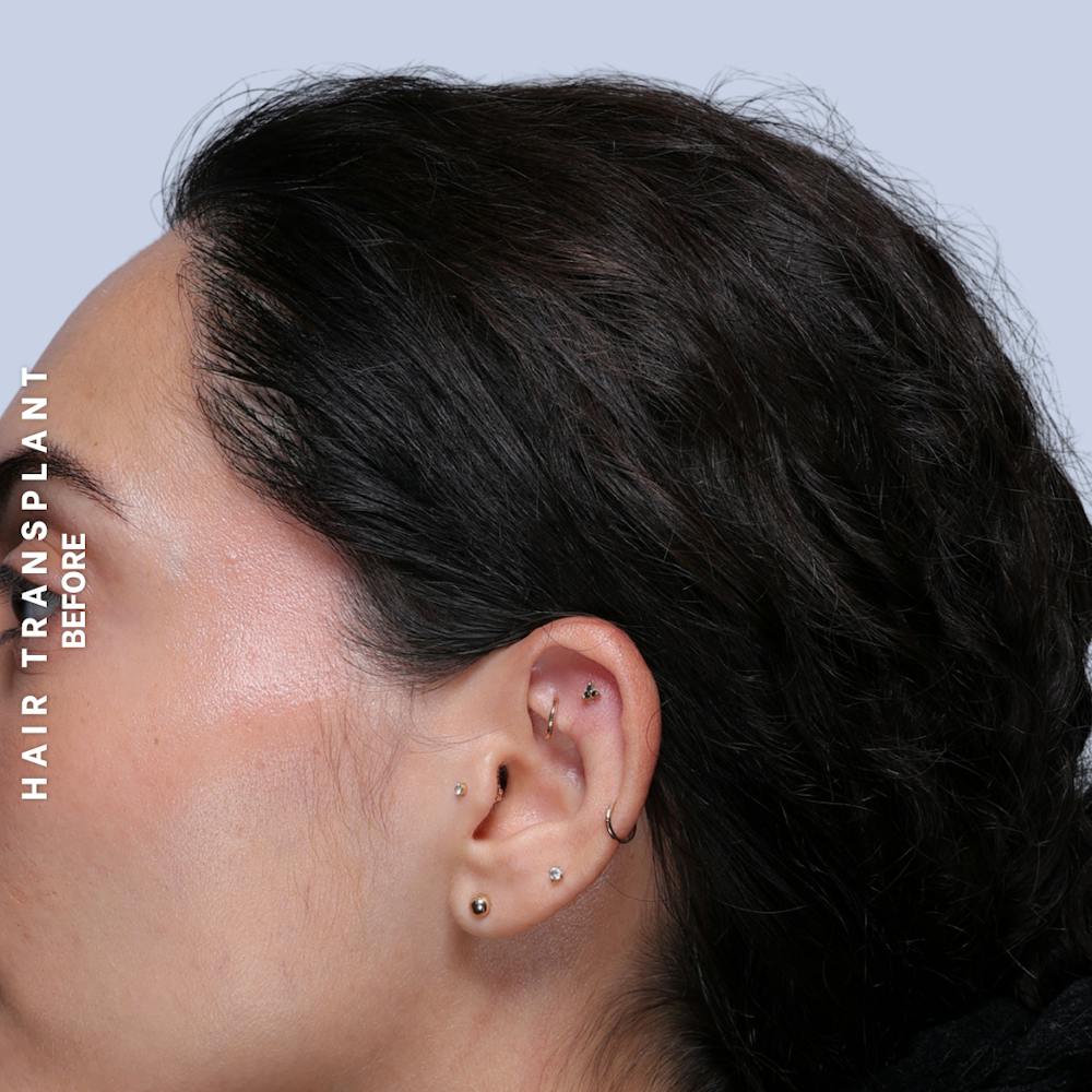 Hair Restoration Before & After Gallery - Patient 463895 - Image 12