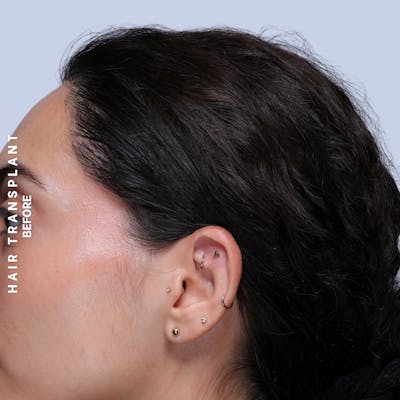 Hair Restoration Before & After Gallery - Patient 463895 - Image 12