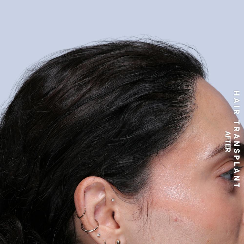 Hair Restoration Before & After Gallery - Patient 463895 - Image 8