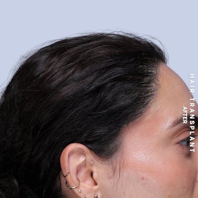 Hair Restoration Before & After Gallery - Patient 463895 - Image 8