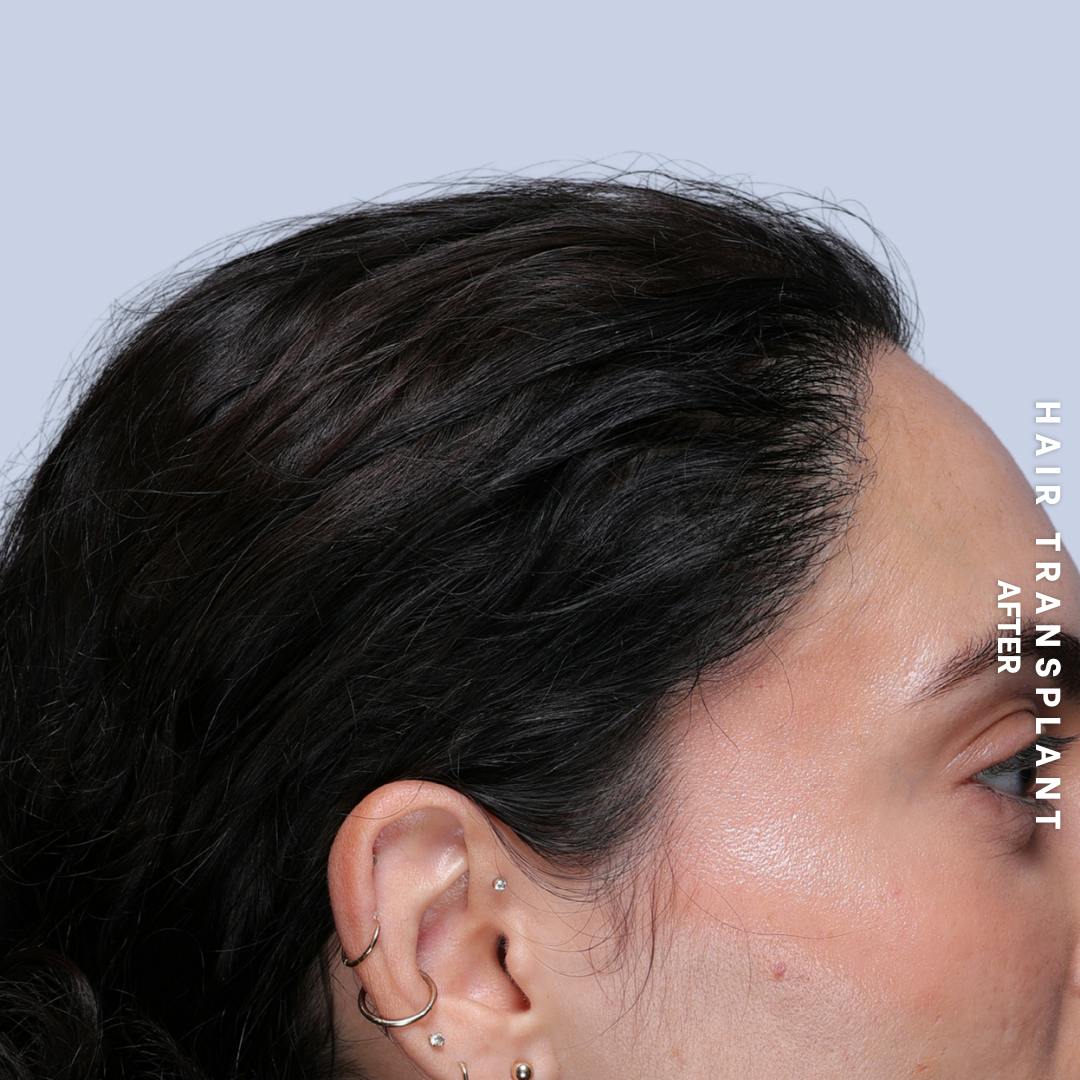 Hair Restoration Before & After Gallery - Patient 463895 - Image 8