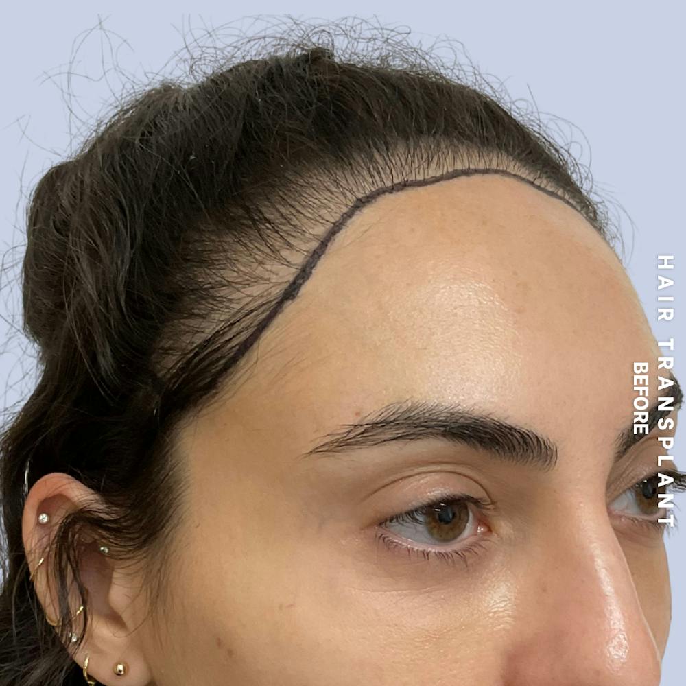 Hair Restoration Before & After Gallery - Patient 463895 - Image 5