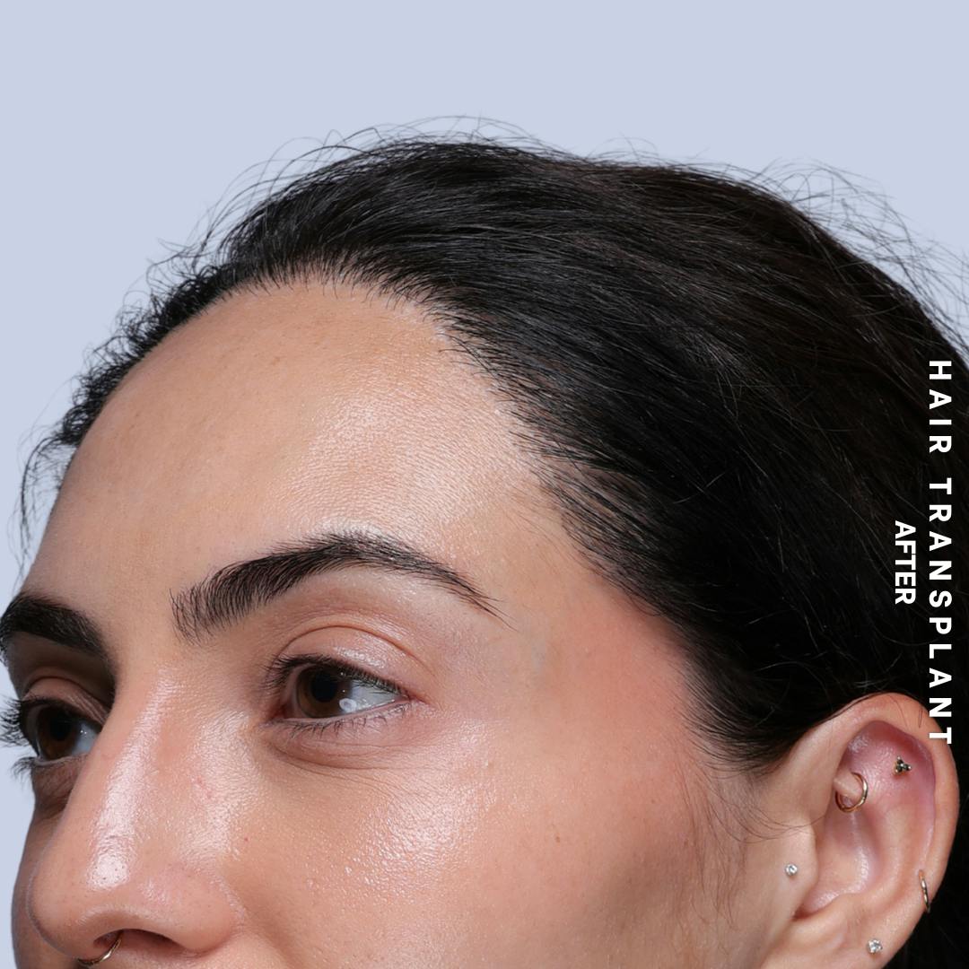 Hair Restoration Before & After Gallery - Patient 463895 - Image 10