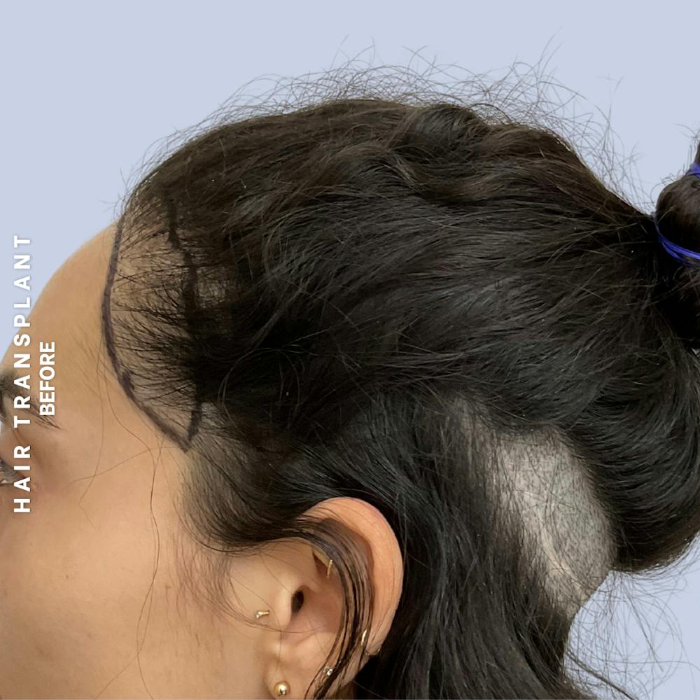 Hair Restoration Before & After Gallery - Patient 463895 - Image 11