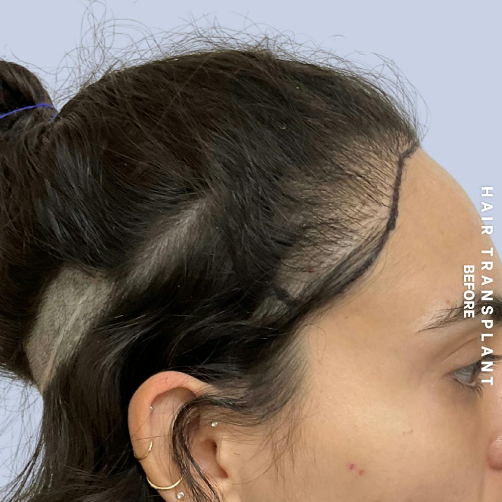 Hair Restoration Before & After Gallery - Patient 463895 - Image 7