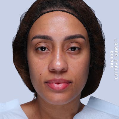 Eyes Before & After Gallery - Patient 265646 - Image 1