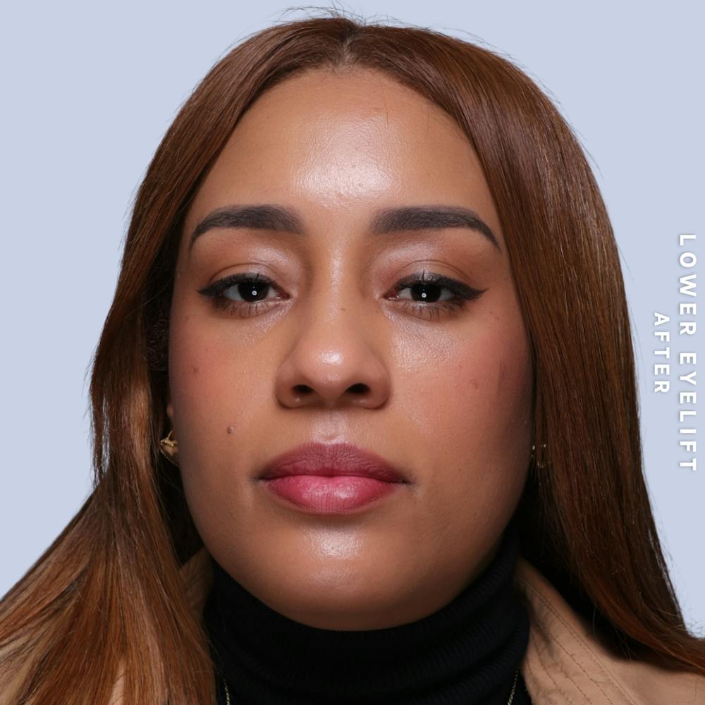 Eyes Before & After Gallery - Patient 265646 - Image 2