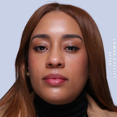 Eyes Before & After Gallery - Patient 265646 - Image 2
