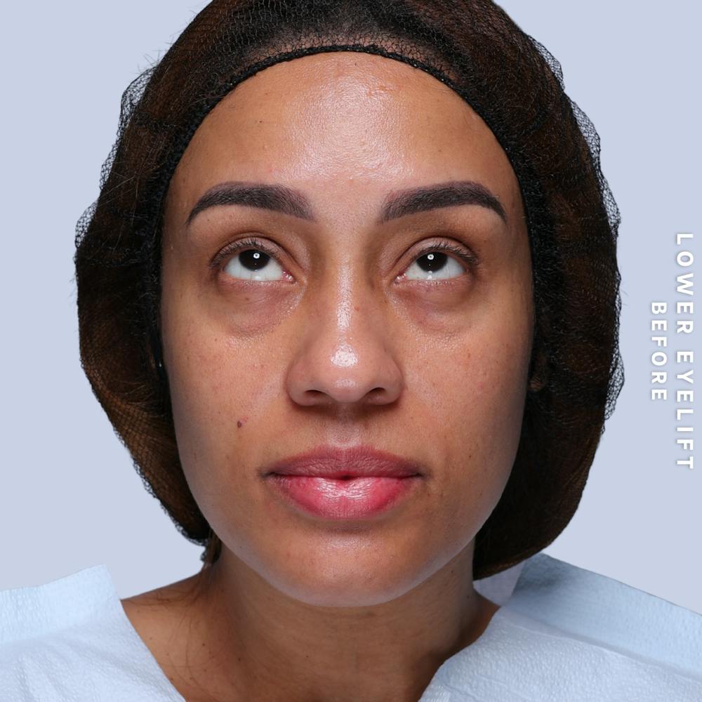 Eyes Before & After Gallery - Patient 265646 - Image 3