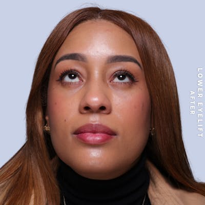 Eyes Before & After Gallery - Patient 265646 - Image 4