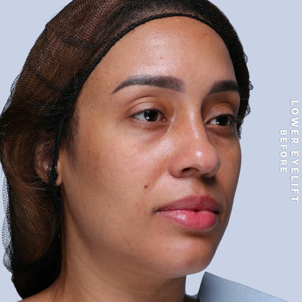 Eyes Before & After Gallery - Patient 265646 - Image 5