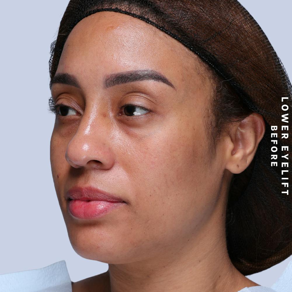 Eyes Before & After Gallery - Patient 265646 - Image 7