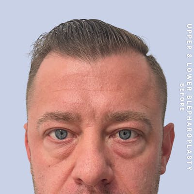 Eyes Before & After Gallery - Patient 125948 - Image 1