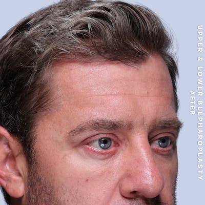 Eyes Before & After Gallery - Patient 125948 - Image 4