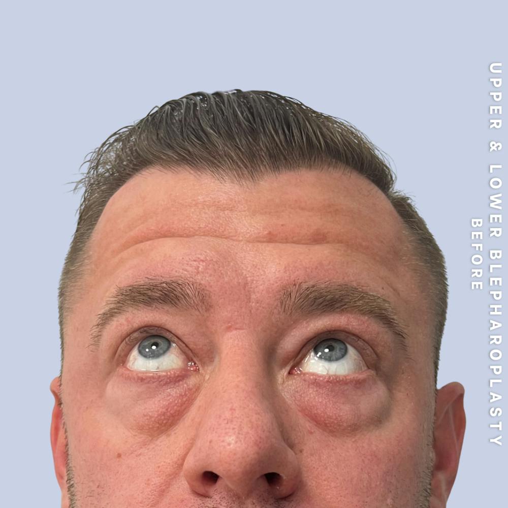 Eyes Before & After Gallery - Patient 125948 - Image 5