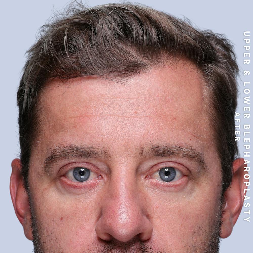 Eyes Before & After Gallery - Patient 125948 - Image 2