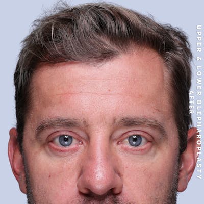 Eyes Before & After Gallery - Patient 125948 - Image 2