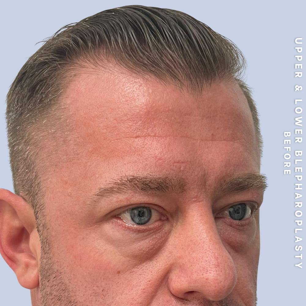 Eyes Before & After Gallery - Patient 125948 - Image 3