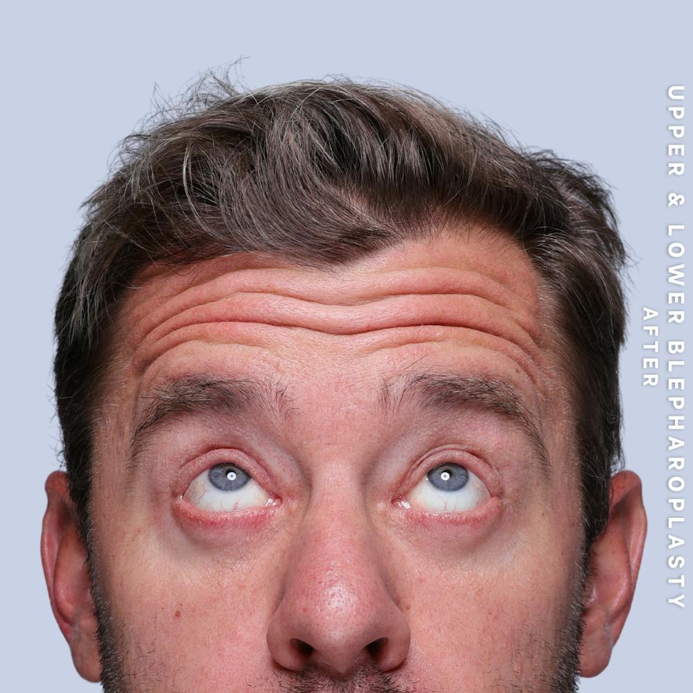 Eyes Before & After Gallery - Patient 125948 - Image 6