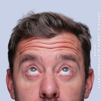 Eyes Before & After Gallery - Patient 125948 - Image 6