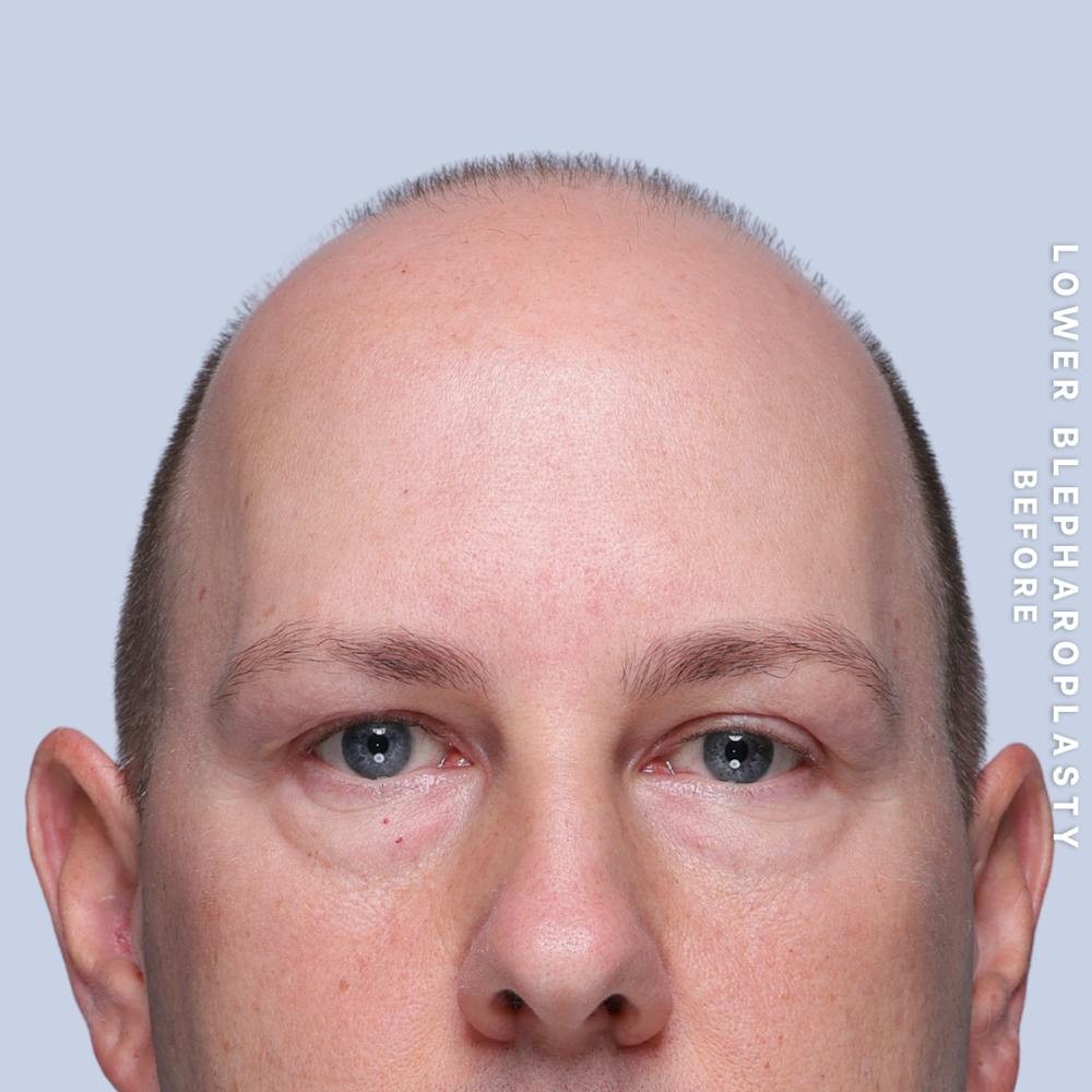 Eyes Before & After Gallery - Patient 170959 - Image 1