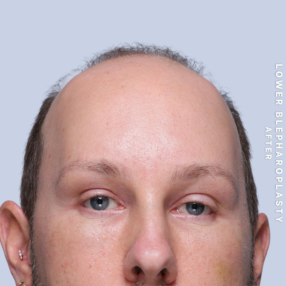 Eyes Before & After Gallery - Patient 170959 - Image 2