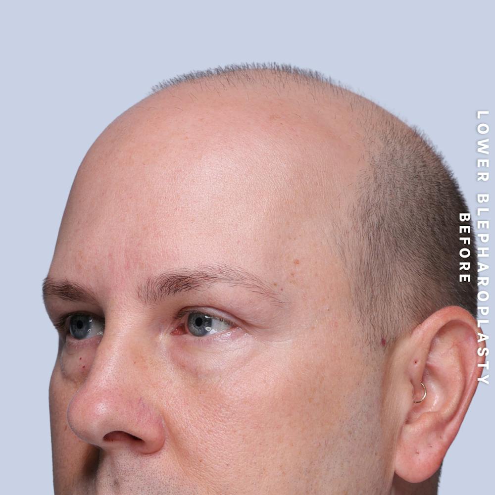 Eyes Before & After Gallery - Patient 170959 - Image 4