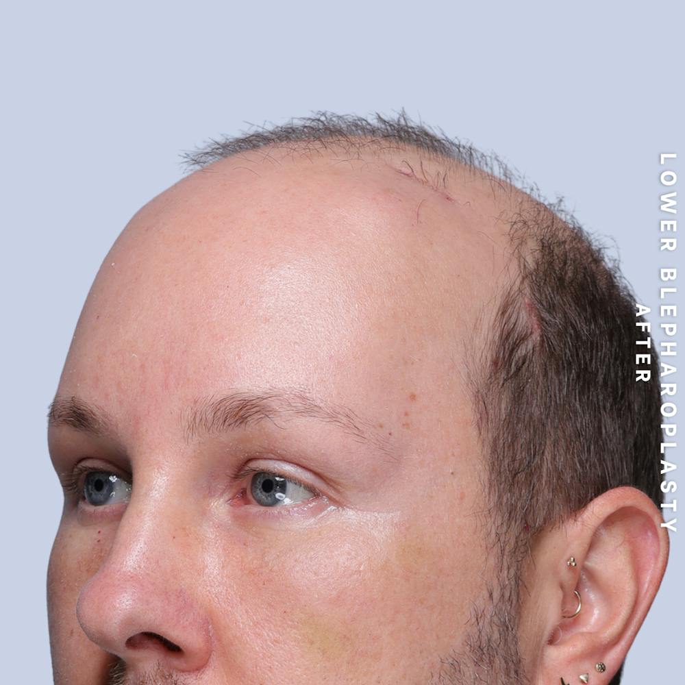 Eyes Before & After Gallery - Patient 170959 - Image 3