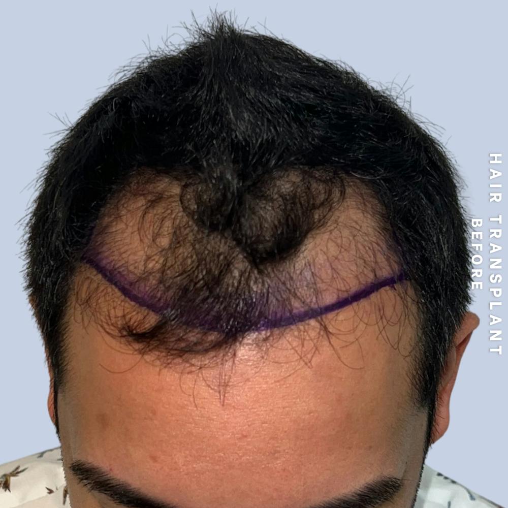 Men's Hair Before & After Gallery - Patient 271697 - Image 1