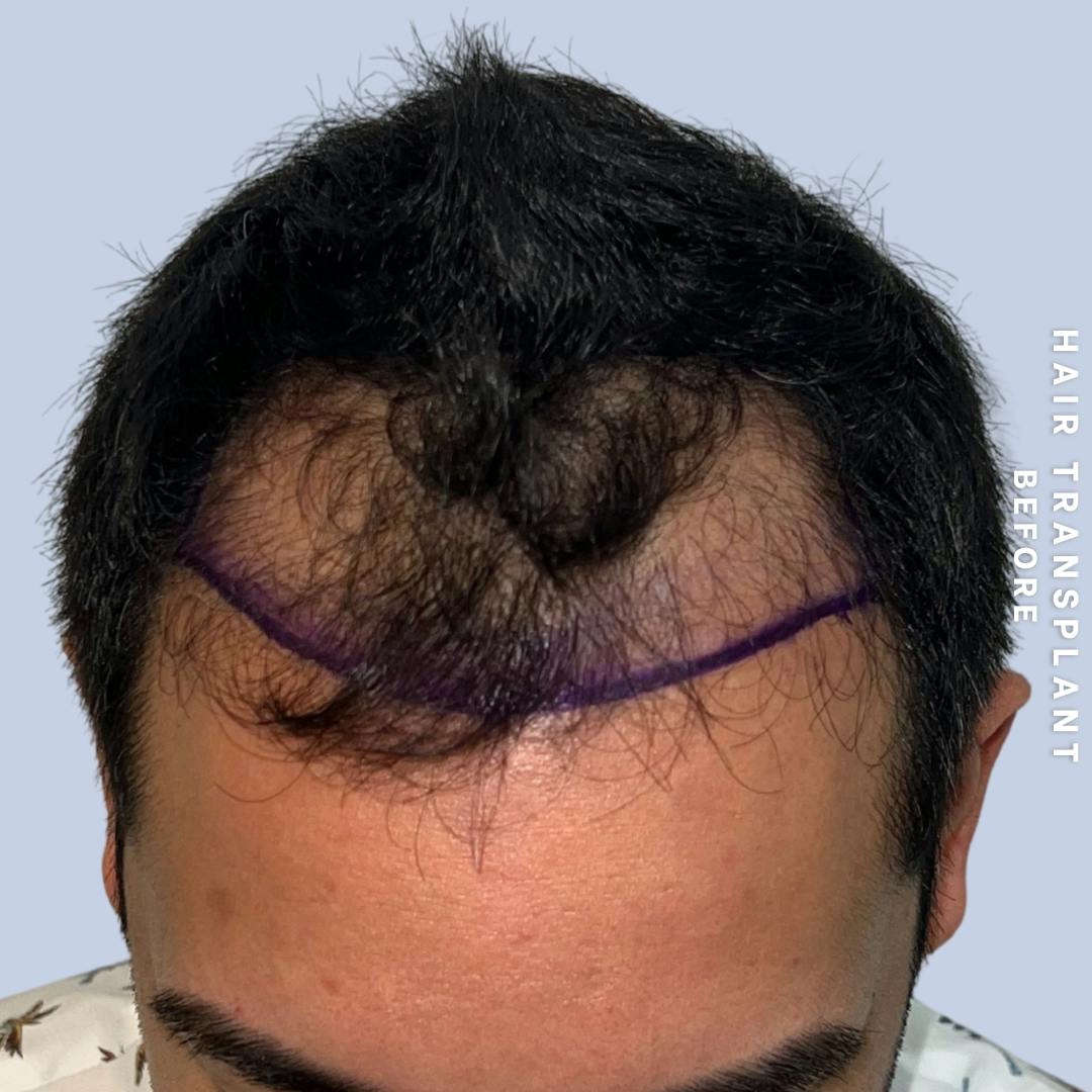 Men's Hair Before & After Gallery - Patient 271697 - Image 1