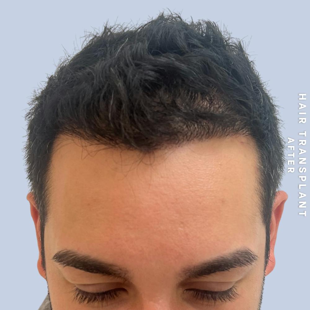 Men's Hair Before & After Gallery - Patient 271697 - Image 2