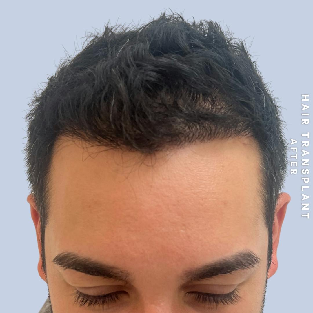 Men's Hair Before & After Gallery - Patient 271697 - Image 2